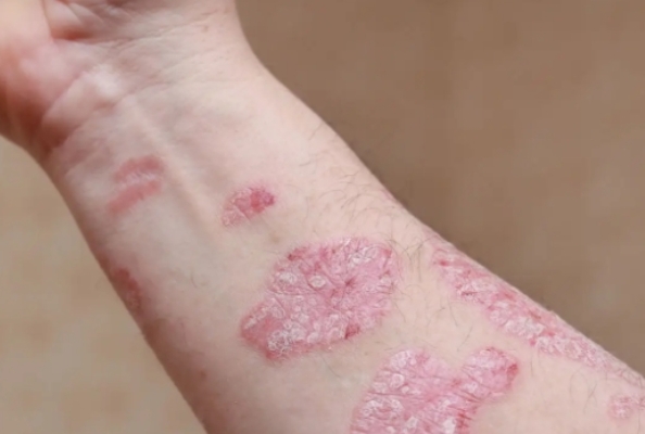 Nanobodies May Hold Promise for a Radical Cure of Psoriasis