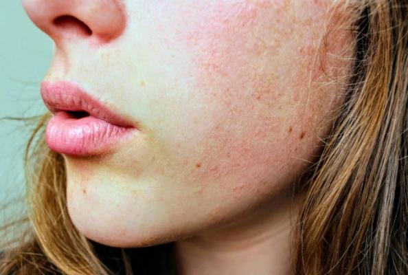 Persistent, Intractable, Itching and Pain Unrelieved: What’s the Future of Eczema Treatment?