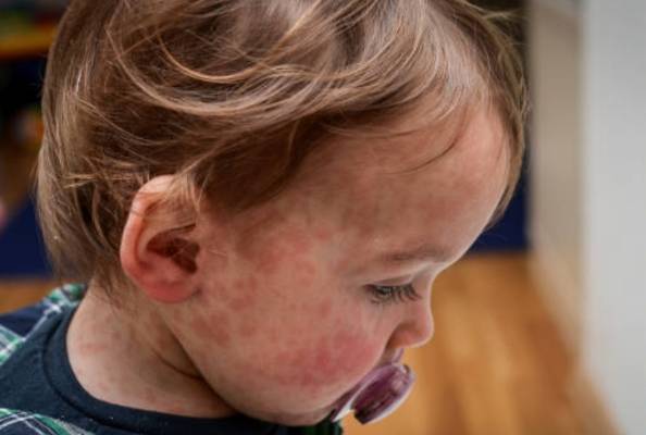 The Road to a Cure for Lupus Erythematosus