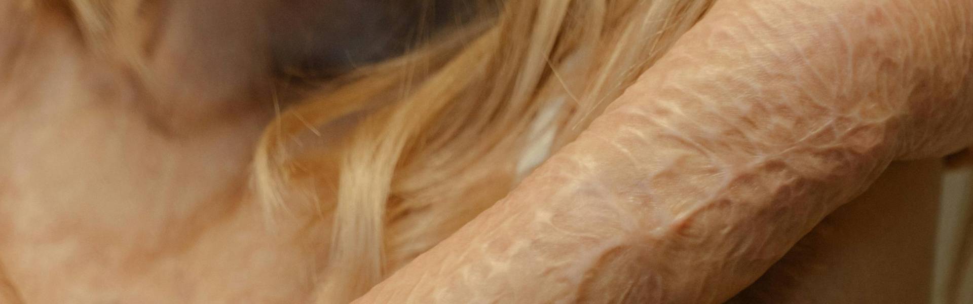 The Once-Irreversible Progression of Tissue Fibrosis May Come to an End