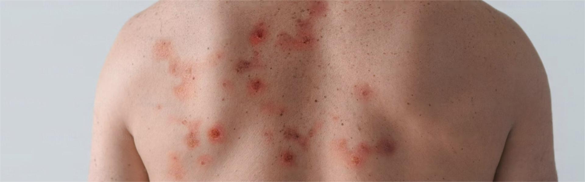 Nanobodies May Hold Promise for a Radical Cure of Psoriasis