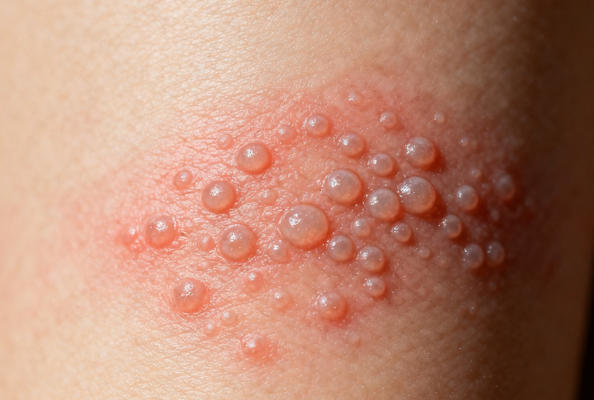 Targeting HSV gB Protein with Nanobodies: A Breakthrough for Herpesvirus Treatment Challenges