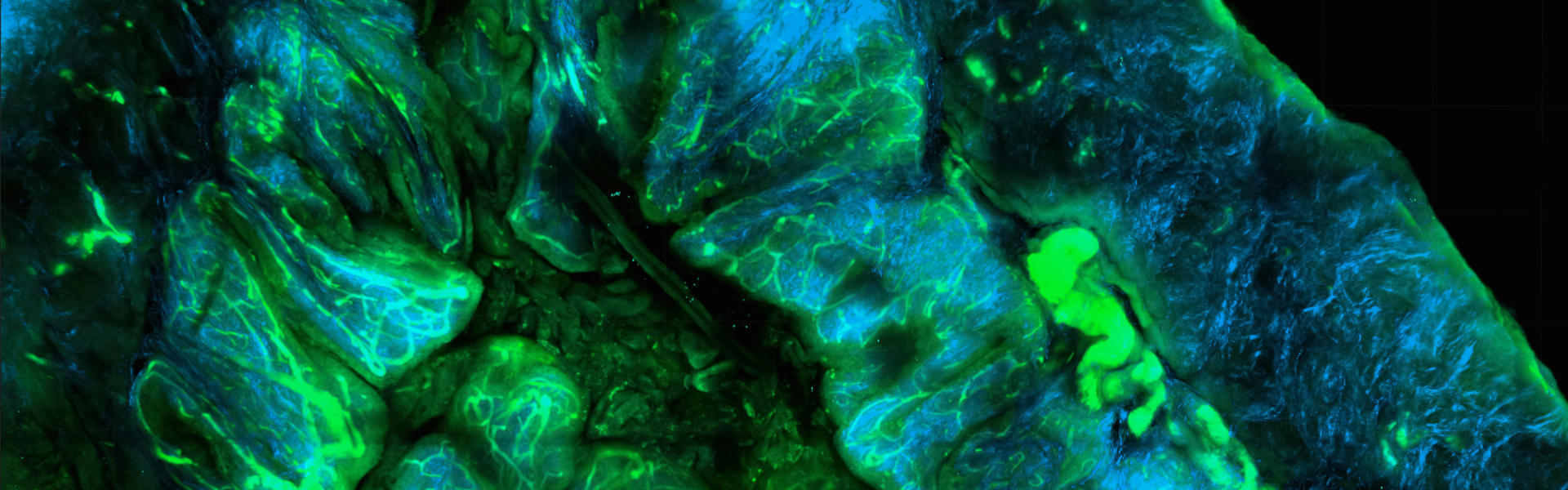 Breaking the Undruggable Barrier: Nanobody PROTACs Enable Novel Therapy for YAP-Driven Cancers