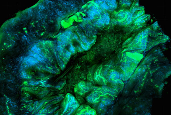 Breaking the Undruggable Barrier: Nanobody PROTACs Enable Novel Therapy for YAP-Driven Cancers