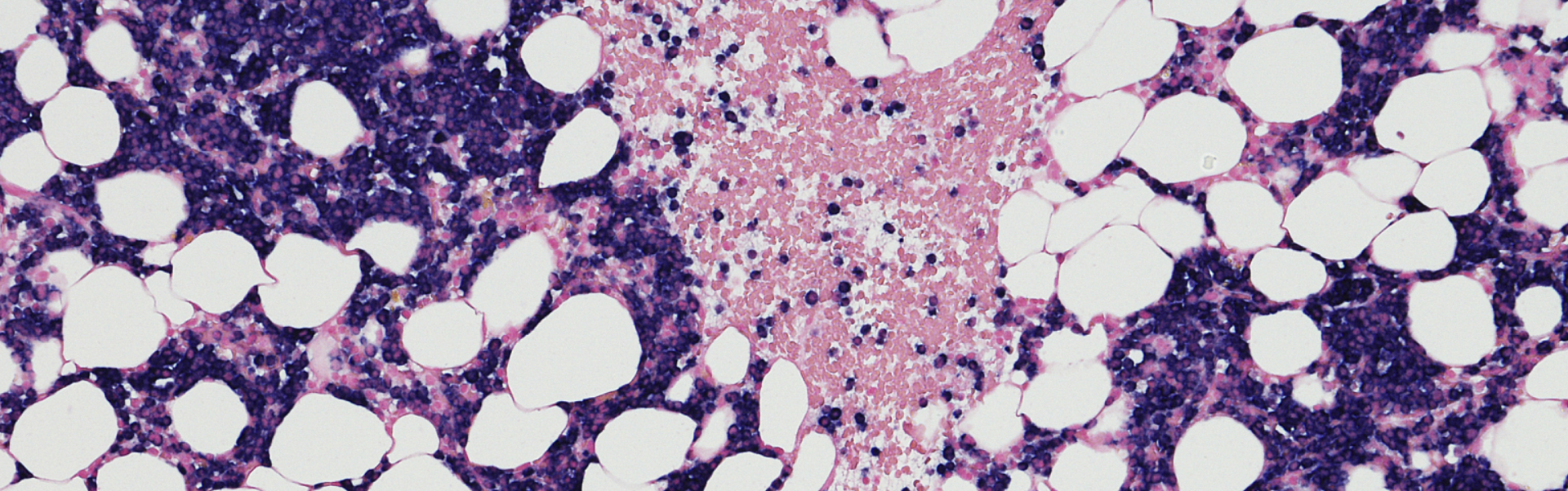 Nanobodies Empower Innovative Drugs! First Patient Dosed in Phase III Clinical Trial of JSKN016